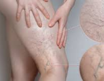 sclerotherapy-image