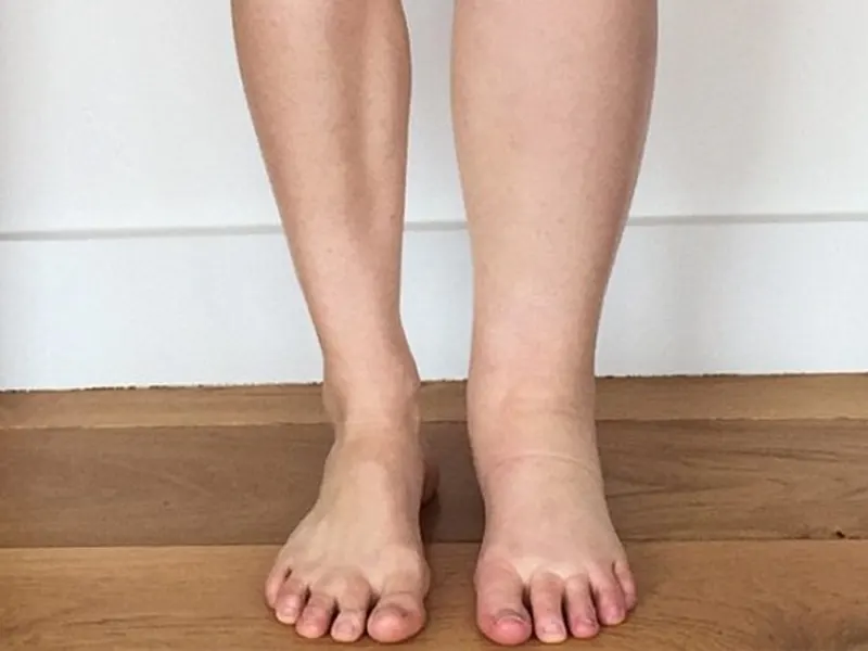 leg-swelling
