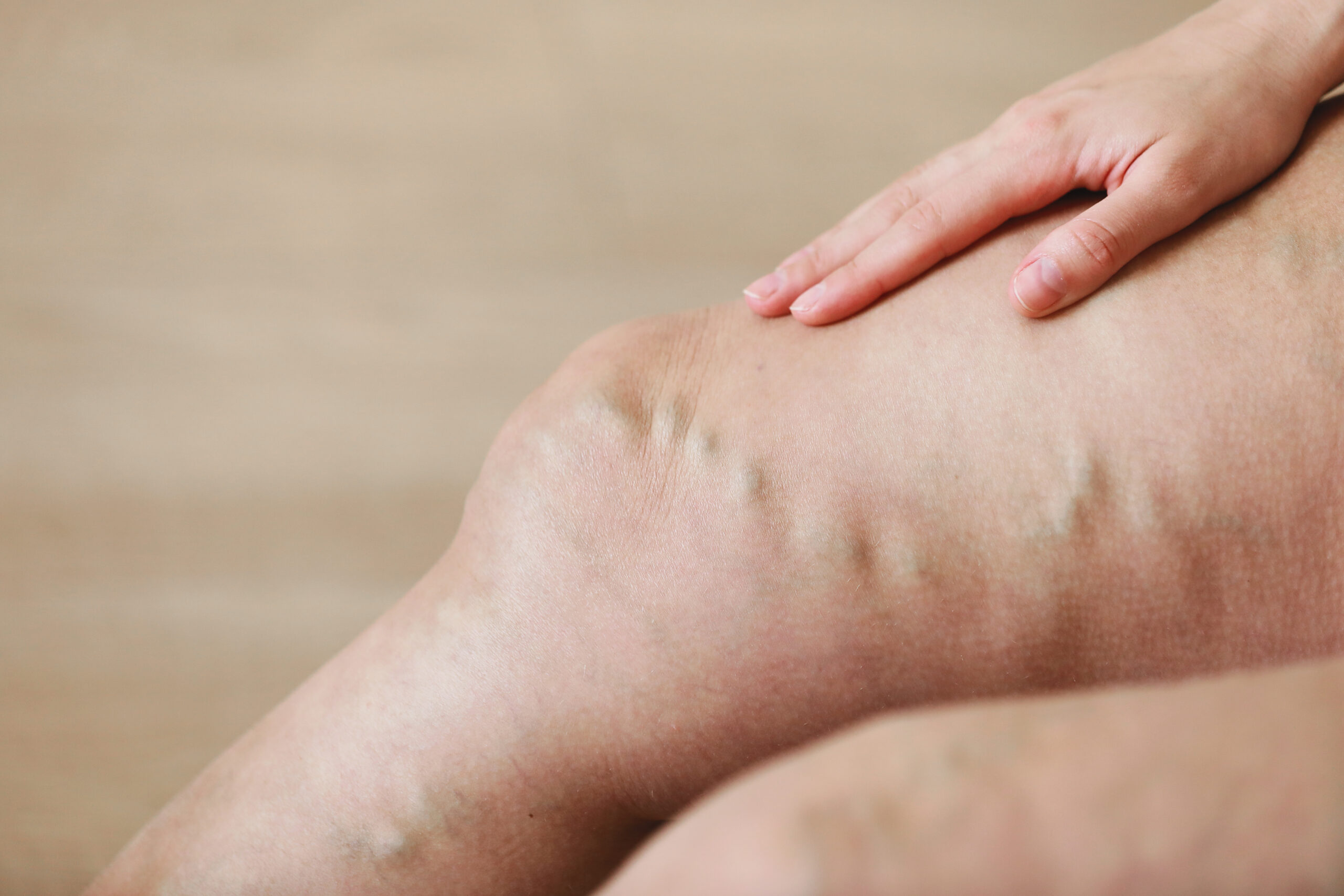 painful-varicose-and-spider-veins-