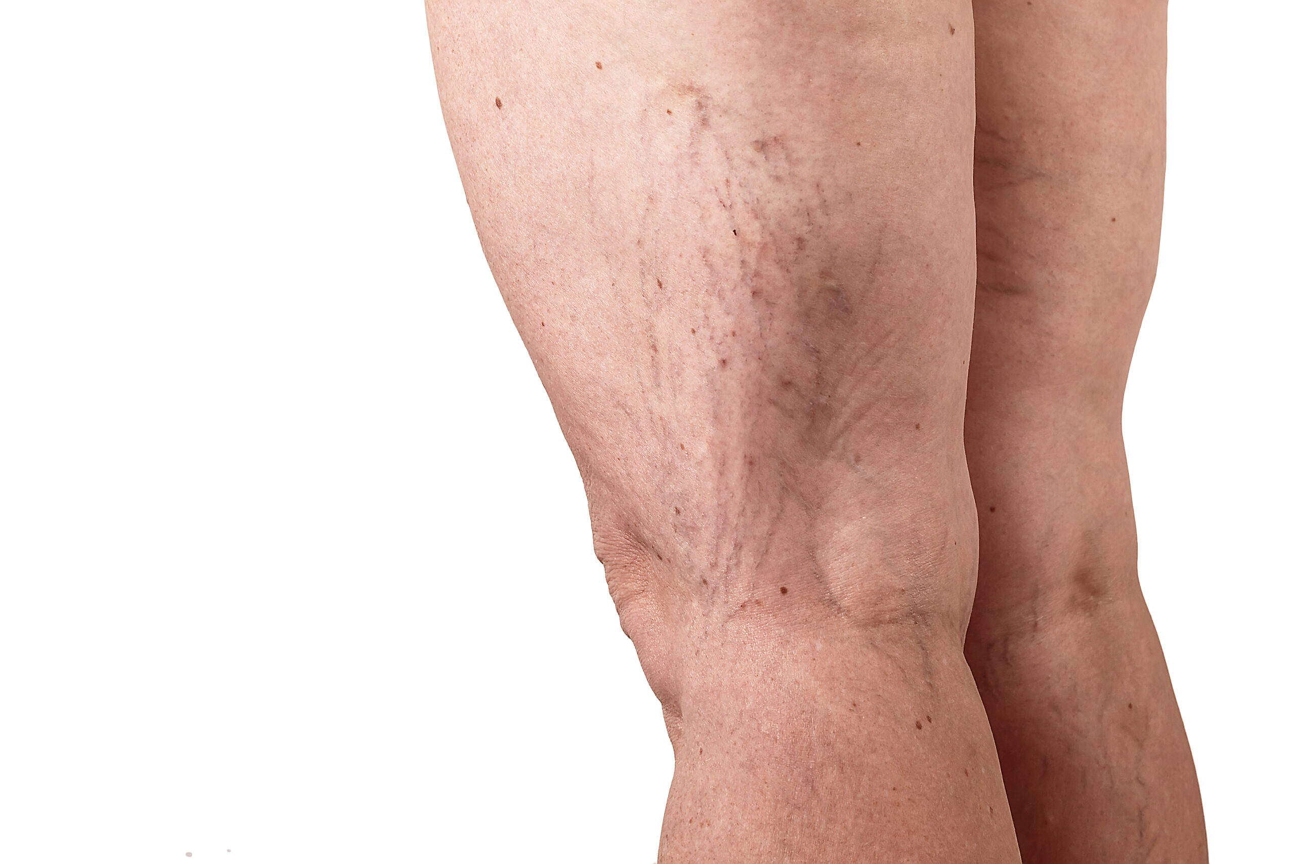 the-disease-varicose-veins-on-a-womans-legs-white