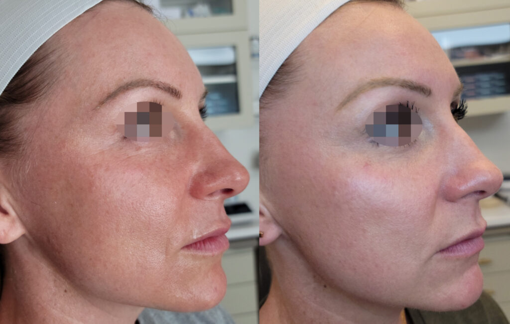 Before - After 1 treatment