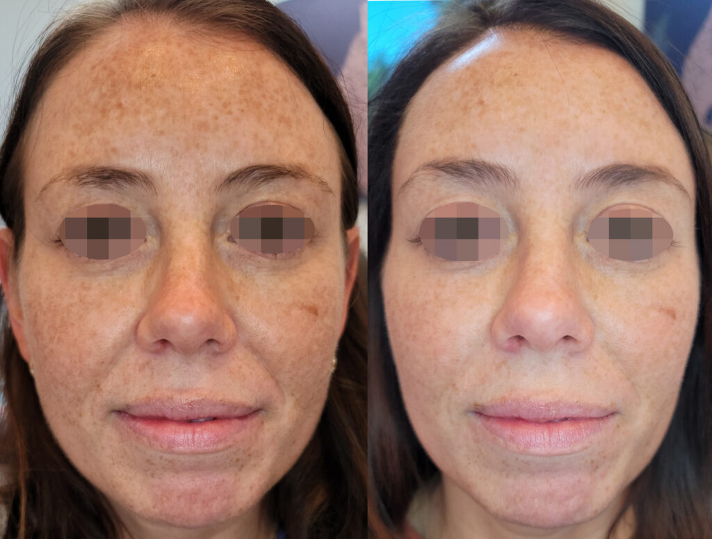 Before - After 1 Treatment