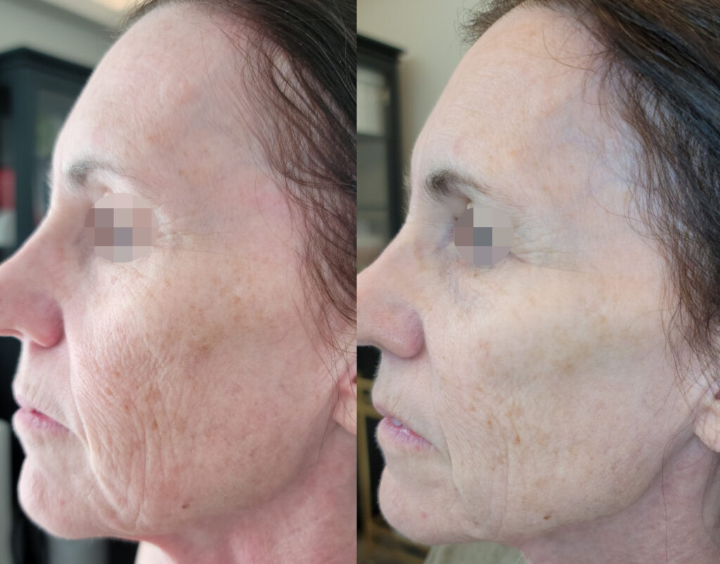 Before - After 1 Treatment 